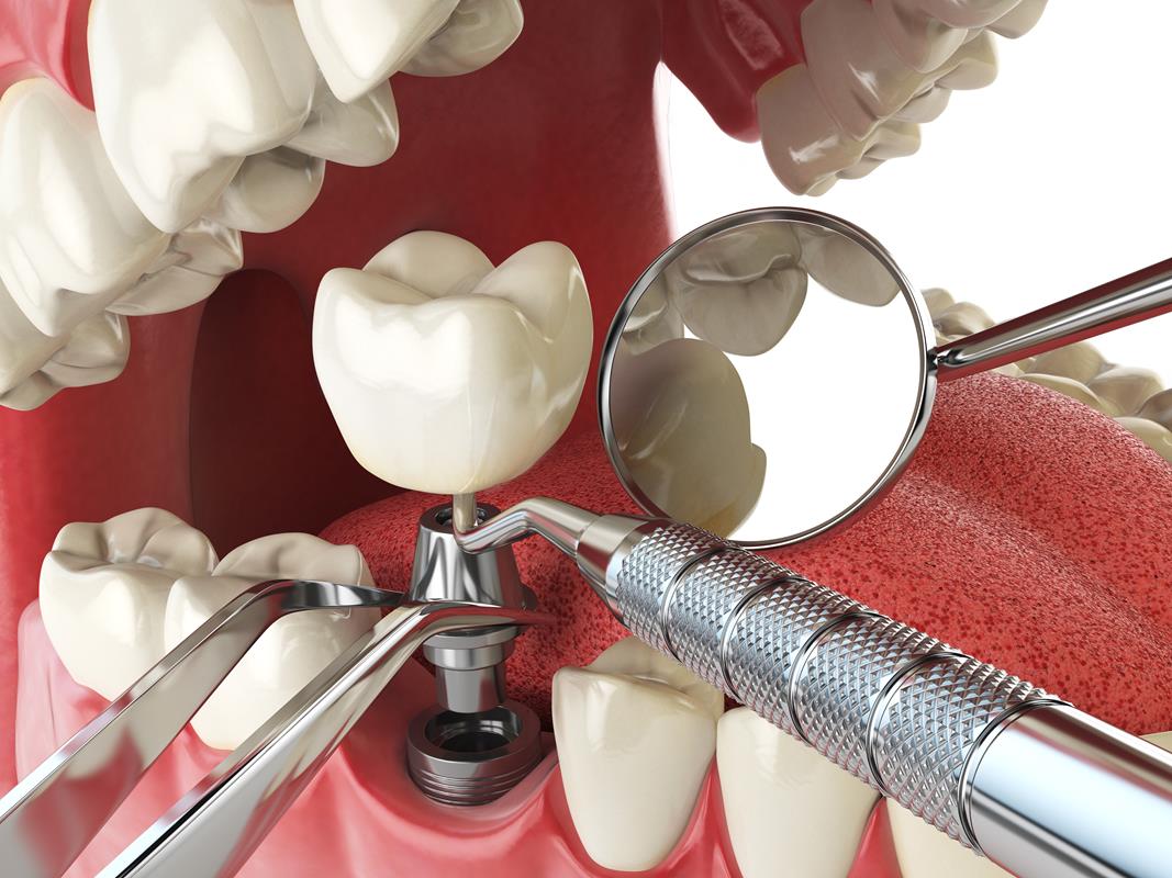 Cosmetic Dental Implant Restoration 